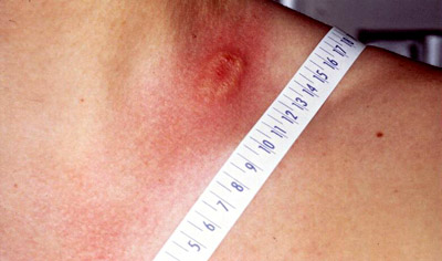 herxheimer reaction symptoms candida dogs